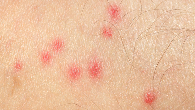 How Long Do Mosquito Bites Last? How Long Do Mosquito Bites Last?